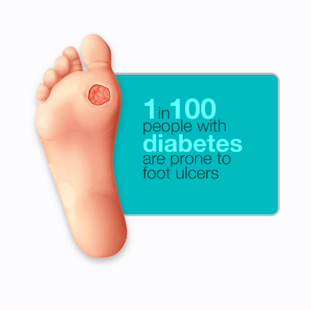 Foot Ulcers Statistics